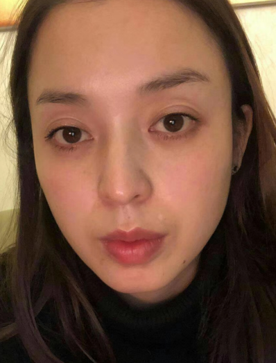 去眼袋手术
