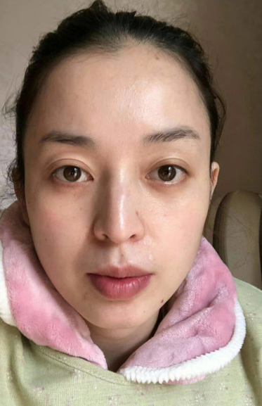 去眼袋手术