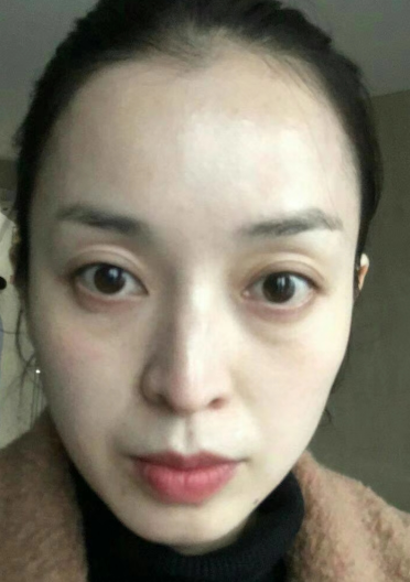 去眼袋手术