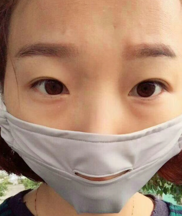 去眼袋手术