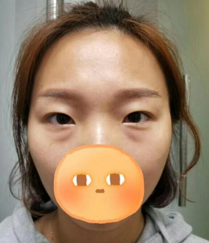 去眼袋手术