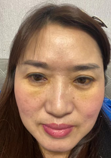 去眼袋手术