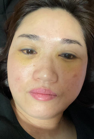 去眼袋手术
