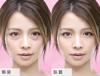 去眼袋手术