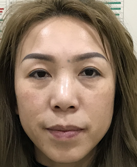 去眼袋手术