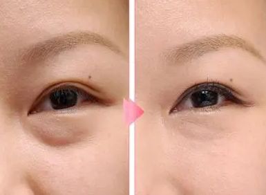去眼袋手术