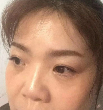 去眼袋手术
