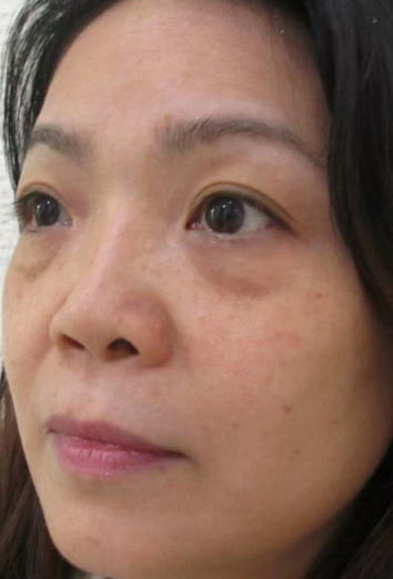去眼袋手术