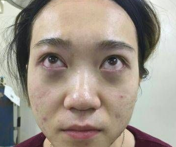 去眼袋手术
