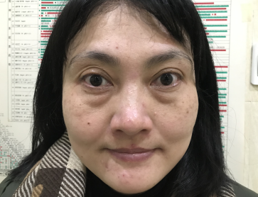 去眼袋手术后