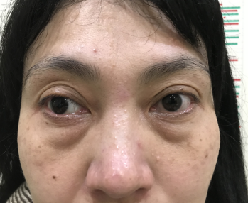 去眼袋手术后
