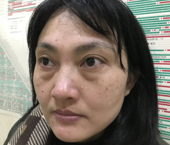 去眼袋手术后