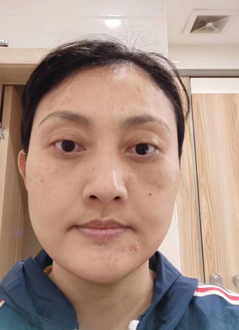 去眼袋手术