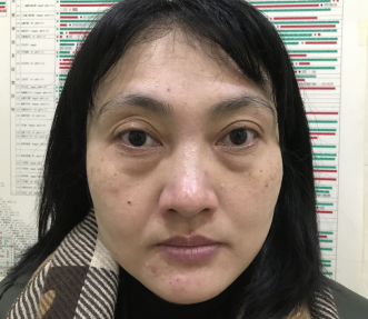 去眼袋手术
