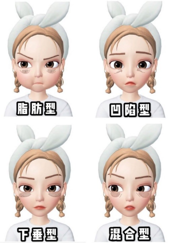 去眼袋手术