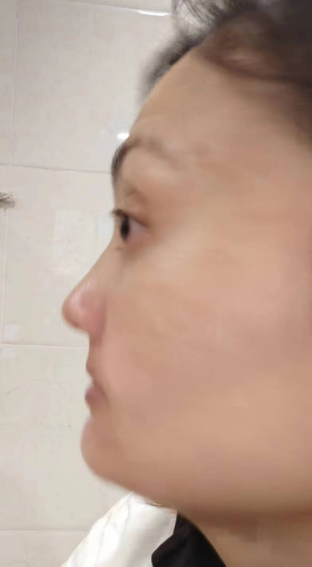 去眼袋手术