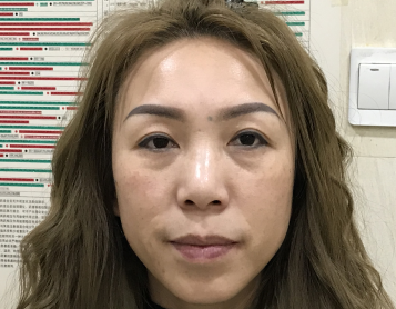 去眼袋手术
