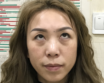 去眼袋手术