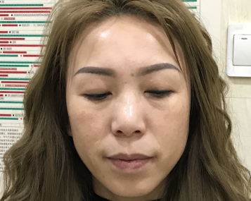 去眼袋手术