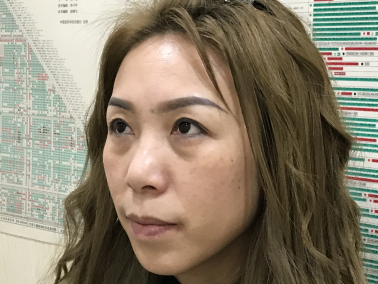 去眼袋手术