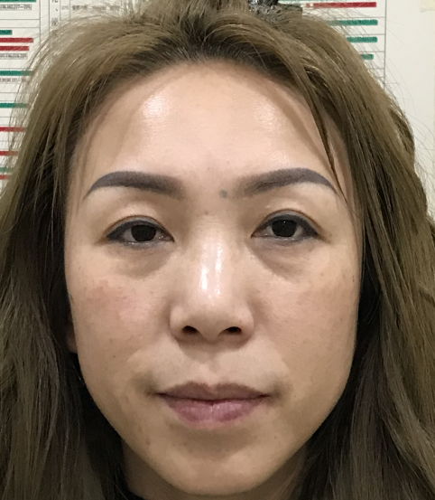 去眼袋手术