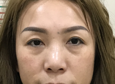 去眼袋手术
