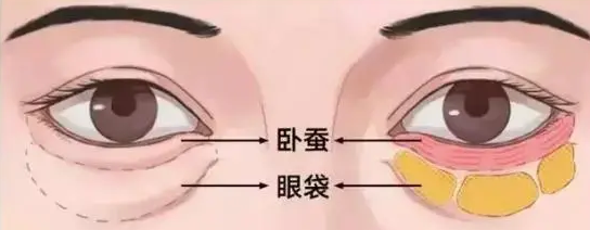 去眼袋手术