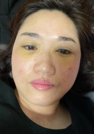 去眼袋手术