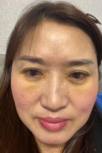 去眼袋手术