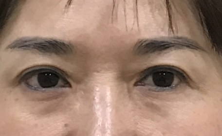 去眼袋手术