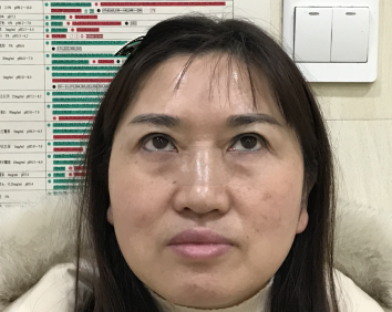 去眼袋手术