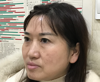 去眼袋手术