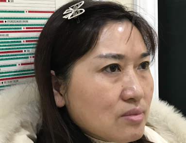 去眼袋手术