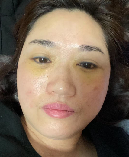 去眼袋手术