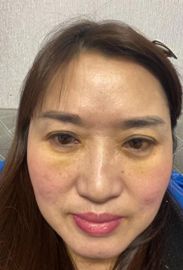 去眼袋手术