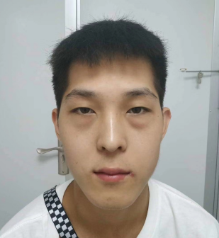 做眼袋如何恢复?想效果好怎么选择方法?968 做眼袋如何恢复?想效果好怎么选择方法?968