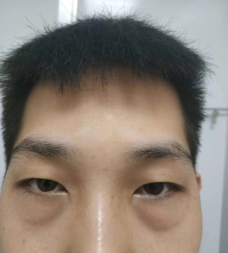 做眼袋如何恢复?想效果好怎么选择方法?968 做眼袋如何恢复?想效果好怎么选择方法?968