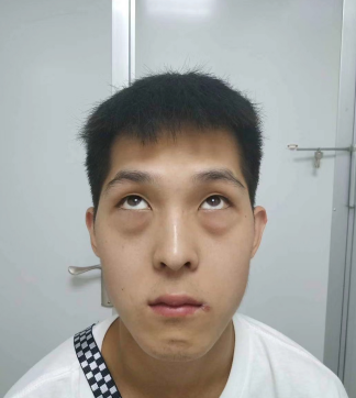 做眼袋如何恢复?想效果好怎么选择方法?968 做眼袋如何恢复?想效果好怎么选择方法?968