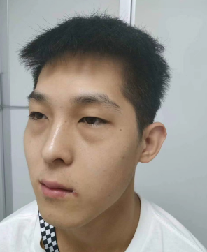 做眼袋如何恢复?想效果好怎么选择方法?968 做眼袋如何恢复?想效果好怎么选择方法?968