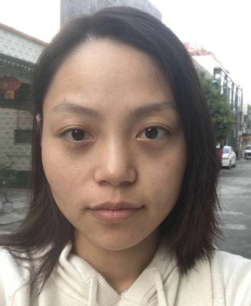 去眼袋手术