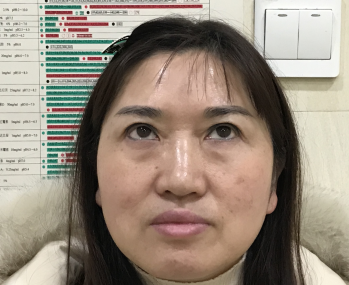 去眼袋手术