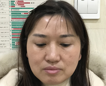 去眼袋手术