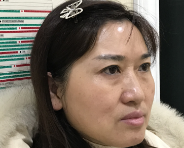 去眼袋手术