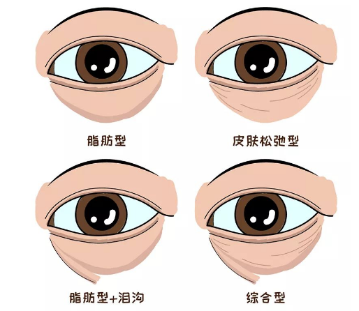去眼袋手术