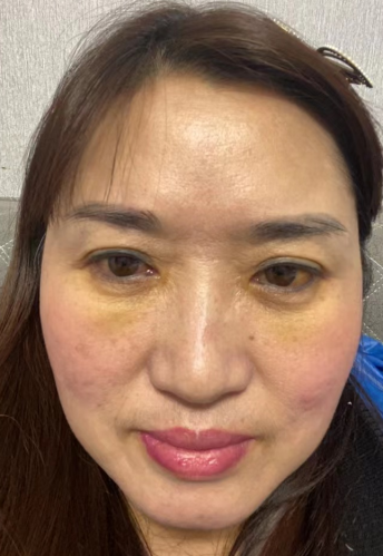 去眼袋手术