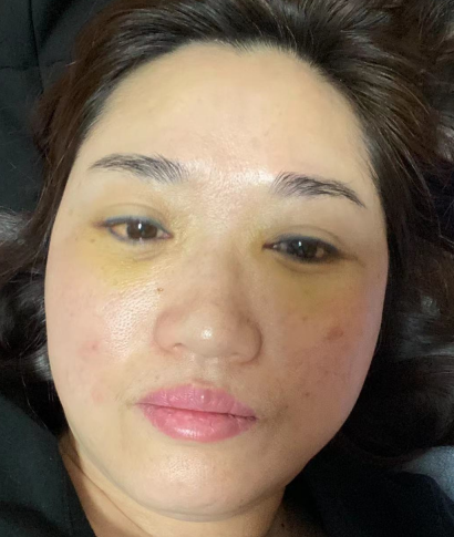 去眼袋手术