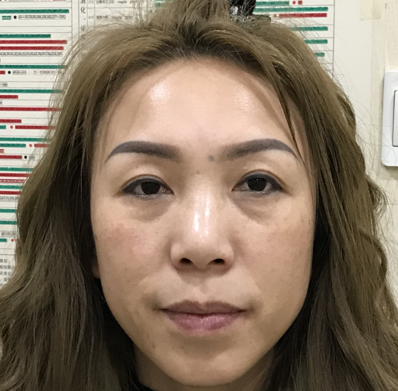去眼袋手术