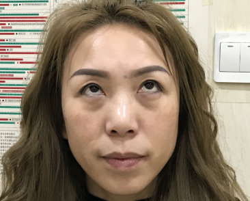 去眼袋手术