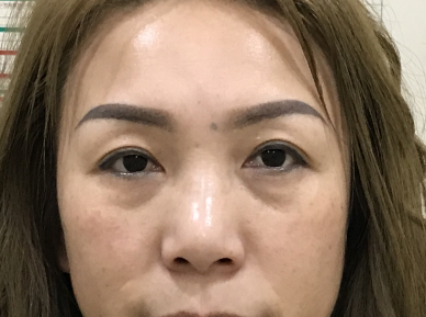 去眼袋手术