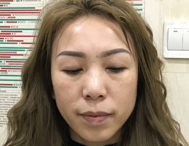 去眼袋手术